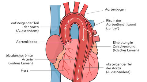 Darstellung der Aorta 