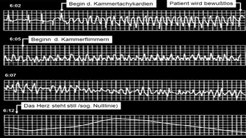 Abbildung-EKG-Kammerflimmern
