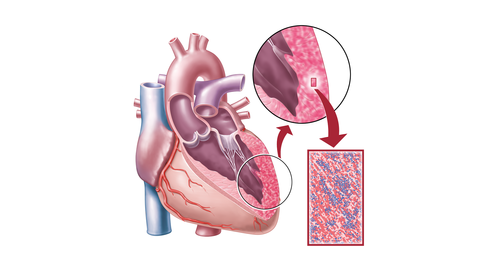  Herzmuskelentzündung (Myokarditis) 