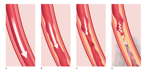 Alle Fakten Zur Angina Pectoris Herzstiftung