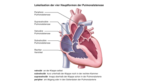 Abbildung Pulmonalstenose