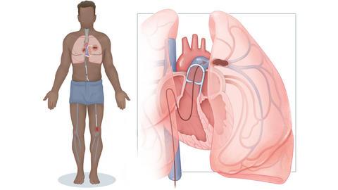 Bild der Lungenembolie